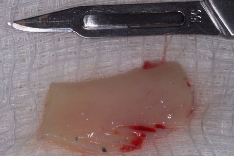 Bloco ósseo removido.