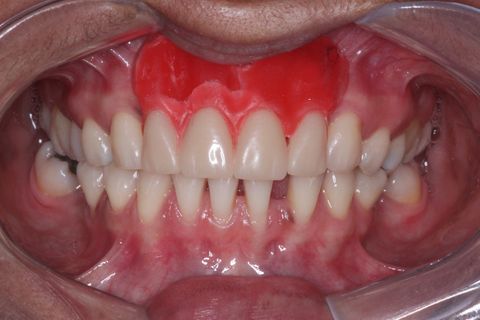 Planejamento Protético. Montagem de dentes de estoque em placa de resina. A cera vermelha mostra a quantidade de osso perdido