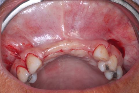 Novo procedimento cirúrgico após 6 mêses. Incisão