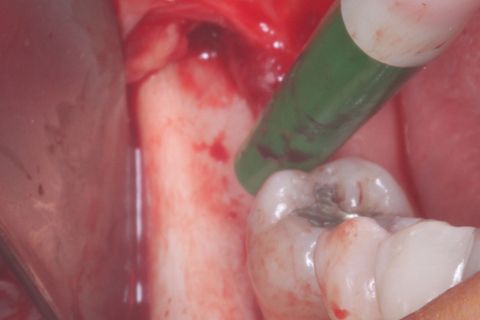 Área doadora: Ramo mandibular ascendente lado direito