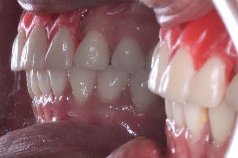 Planejamento Protético . Foto Perfil