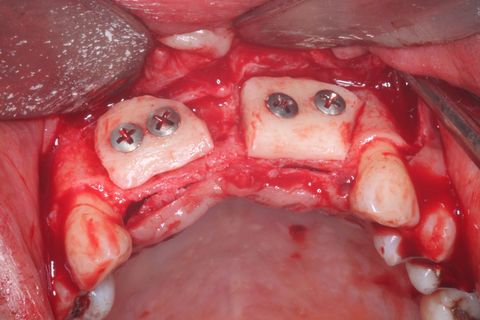 fixação do bloco ósseo com parafusos de cabeça expandida Neodent.