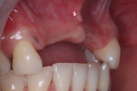 Notar defeito ósseo.