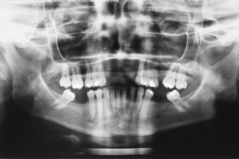 Radiografia Panorâmica inicial