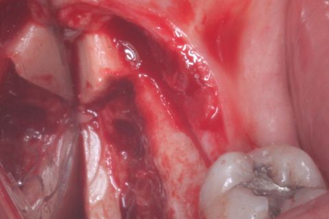 Área doadora: Ramo mandibular ascendente lado direito, após a remoção do bloco ósseo.