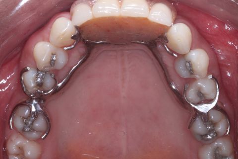 Foto oclusal superior