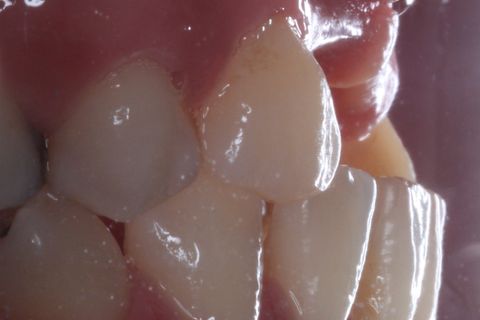 Foto perfil aproximada. Acentuado defeito ósseo na região vestibular