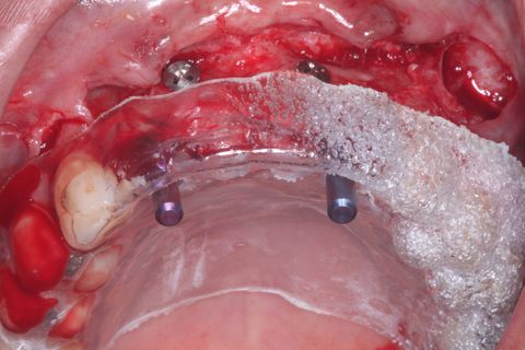 Guia Cirúrgico e paralelizadores conferindo o ângulo de Fresagem/Inserção dos implantes