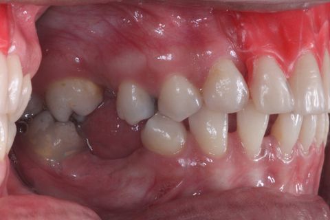 Planejamento Protético . Foto Perfil