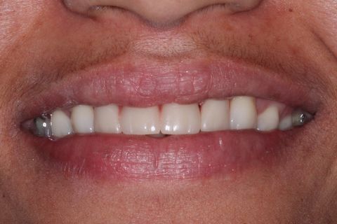 Planejamento Protético. Foto Sorriso