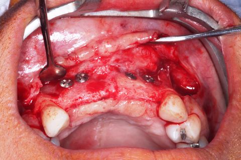 Descolamento Mucoperiosteal. Notar o ganho em expessura óssea.