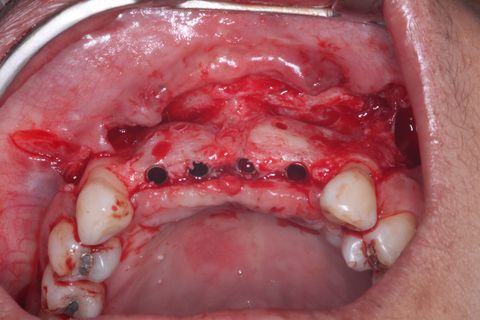 Implantes Neodent Instalados