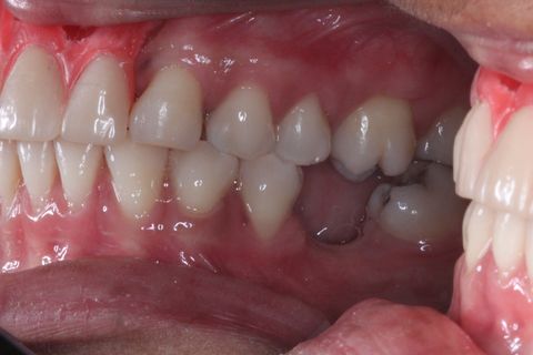 Planejamento Protético . Foto Perfil