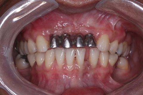 Prova da Subestrutura metálica