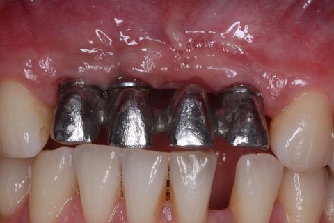 Enxerto Ósseo Autógeno em Região de Incisivos Superiores e Posterior Instalação de Implantes