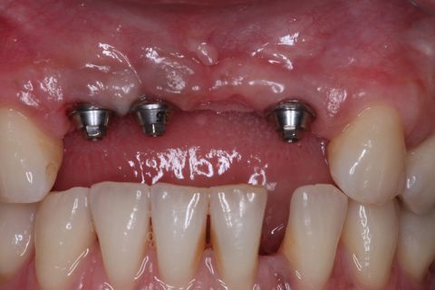 Enxerto Ósseo Autógeno em Região de Incisivos Superiores e Posterior Instalação de Implantes