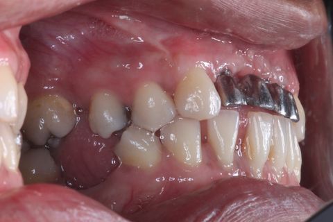 Enxerto Ósseo Autógeno em Região de Incisivos Superiores e Posterior Instalação de Implantes