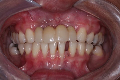 Provisórios instalados . Foto com um ano e meio após a instalação do enxerto e dos implantes. Paciente não compareceu antes para a finalização do trabalho devido problemas particulares