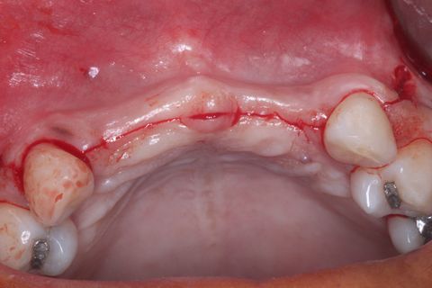 Procedimento cirúrgico. Incisão Supra crestal, intra-sulcular e oblíqua na distal dos caninos