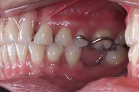 Foto Perfil (uso de espelho). Lado Direito