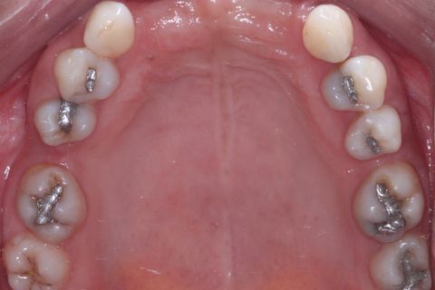 Foto Oclusal superior sem a Prótese Parcial removível