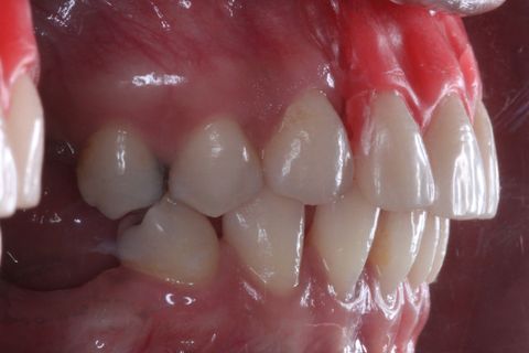 Planejamento Protético . Foto Perfil aproximado