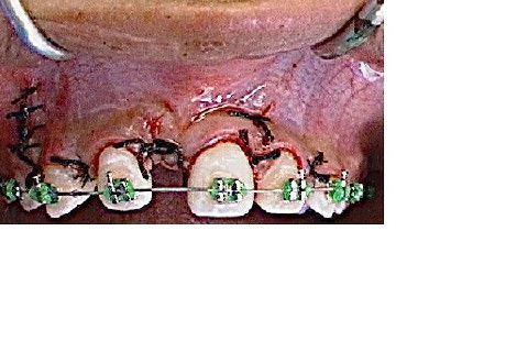 condição imediatamente após a cirurgia;
