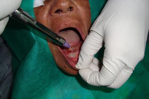 Anestesia infiltrativa local com articaína