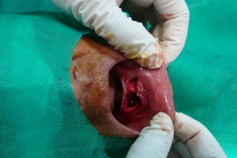 Lesão removida (loja cirúrgica)