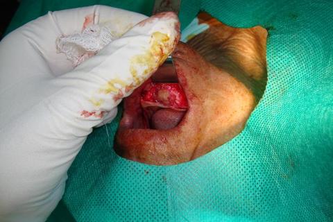 Exposição do sítio cirúrgico