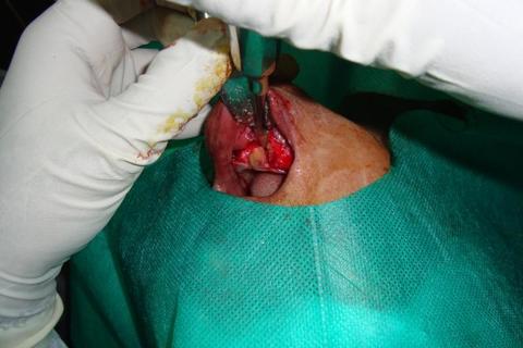 Remoção da lesão após a confecção das canaletas