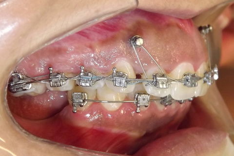 Foto após 22 meses.