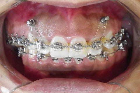 Foto após 22 meses.