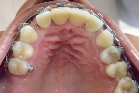 Foto após 22 meses.