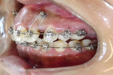 Foto após 22 meses.