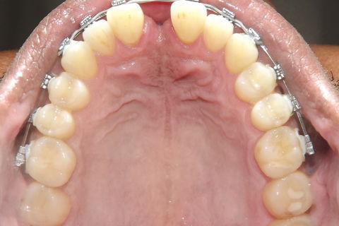 Fechamento de Diastema