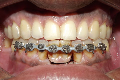 fotos finais, paciente encaminhado para implantes.