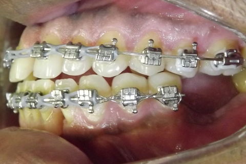 Fechamento de Diastema