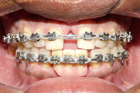 Fechamento de Diastema
