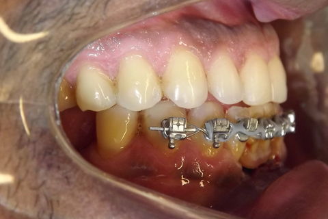 fotos finais, paciente encaminhado para implantes.