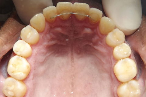 fotos finais, paciente encaminhado para implantes.