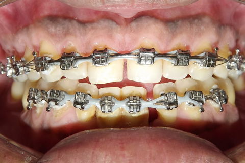 Fechamento de Diastema