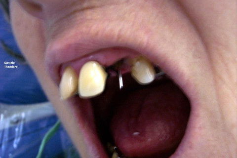 colocação do fio de orto para colocação da coroa provisória.Removi a guta percha em 1/3 do canal radicular