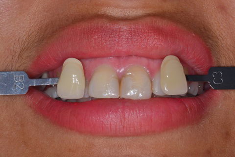 Registro da cor antes do clareamento