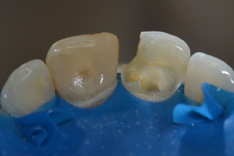 Remoção da restauração antiga (11)