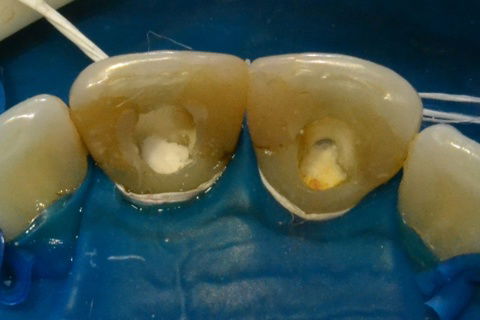 Colocação do agente neutralizante