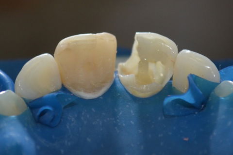 Cimentação do pino de fibra de vidro (11)