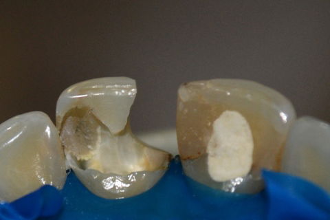 Remoção da restauração antiga (21)