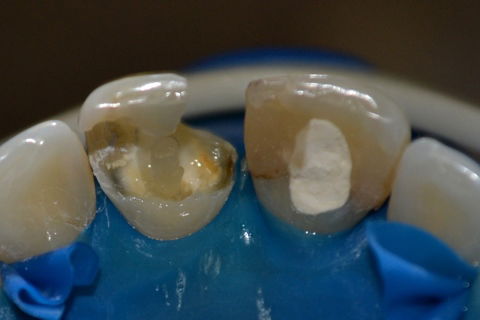 Cimentação do pino de fibra de vidro (21)