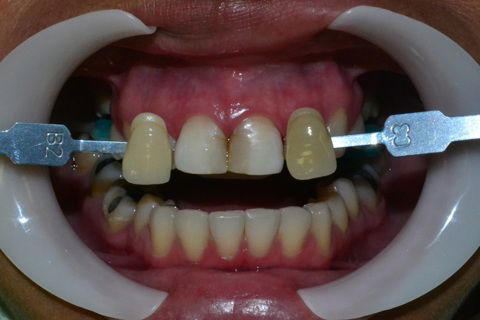 Registro da cor após 1 sessão